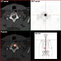 Natriumfluorid-PET/CT desselben Patienten: Die osteolytische Knochenmetastase in der Halswirbelsäule zeigt einen extremen Uptake und ist klar erkennbar. Die beiden weiteren Knochenmetastasen in der Lendenwirbelsäule stellen sich in der PET/CT-Aufnahme ebenfalls sehr gut dar.